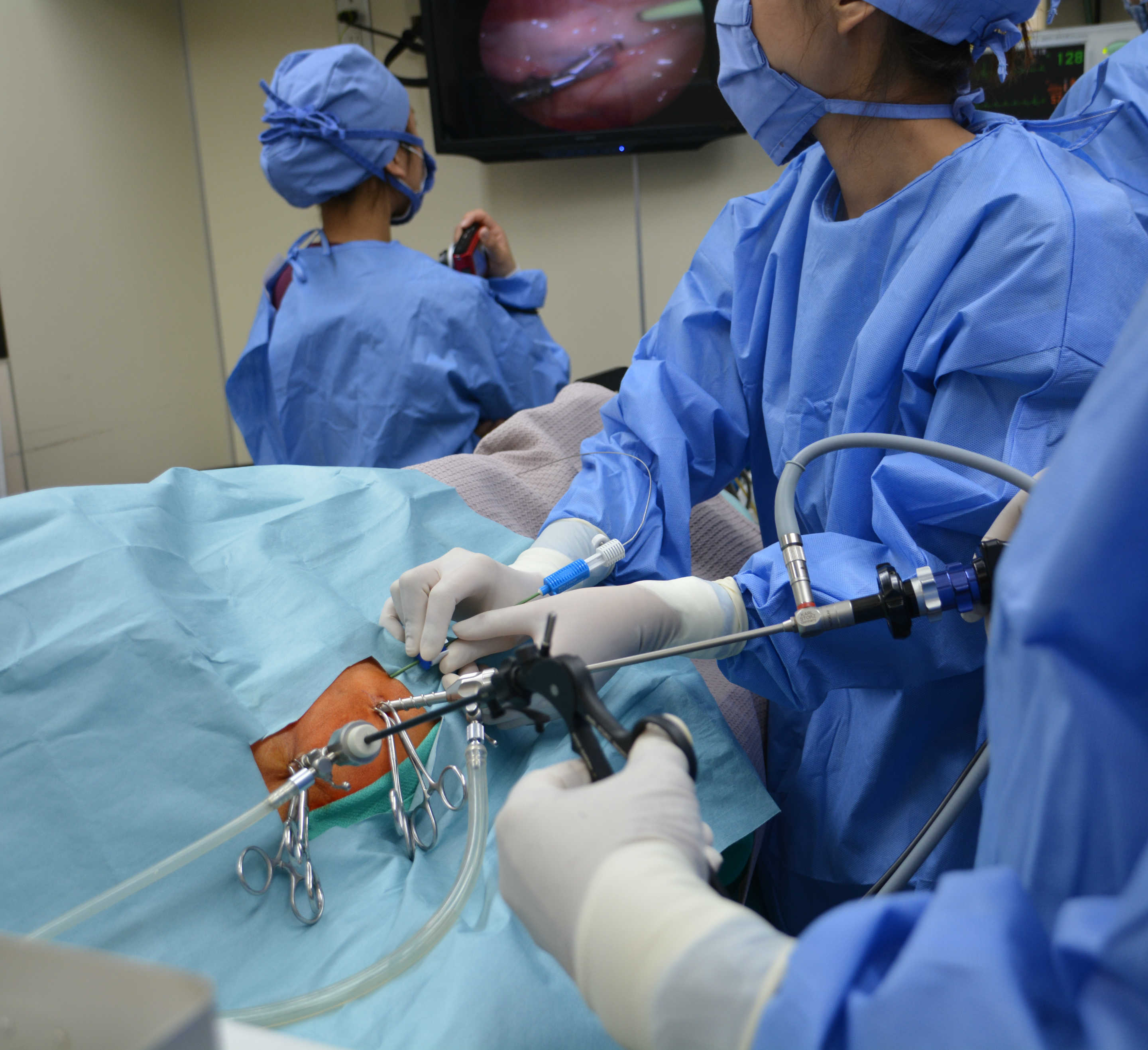 避妊手術 傷が小さい