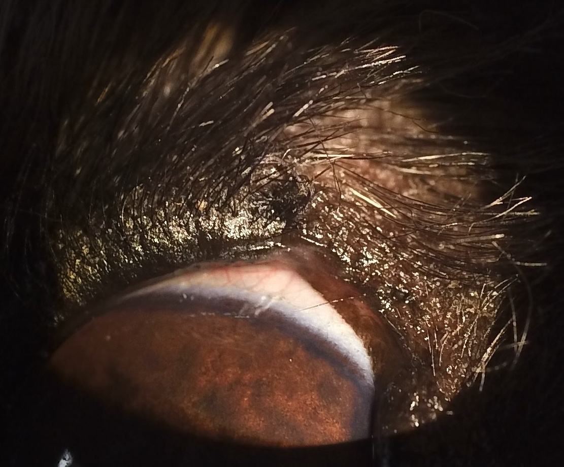 タッキング 内反