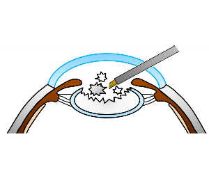 白内障手術 海老名