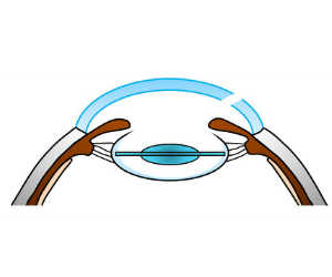 白内障手術 町田