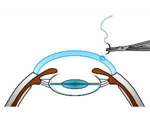 白内障手術 大和