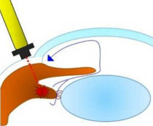 緑内障 レーザー