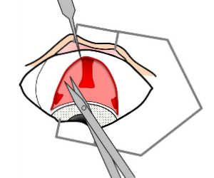ゴニオインプラント