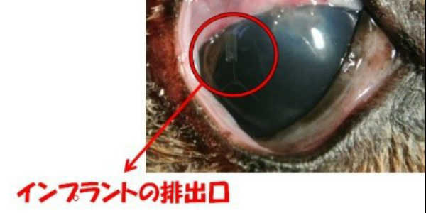 緑内障　排水