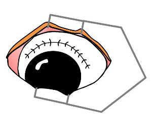 白内障手術　大和