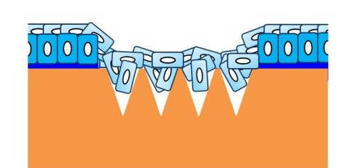 角膜 格子状切開