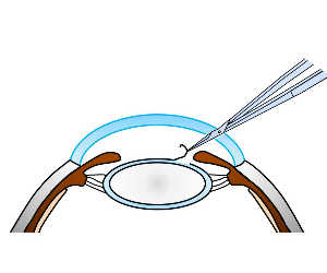 白内障手術 厚木
