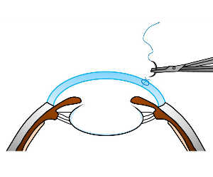 白内障手術 大和