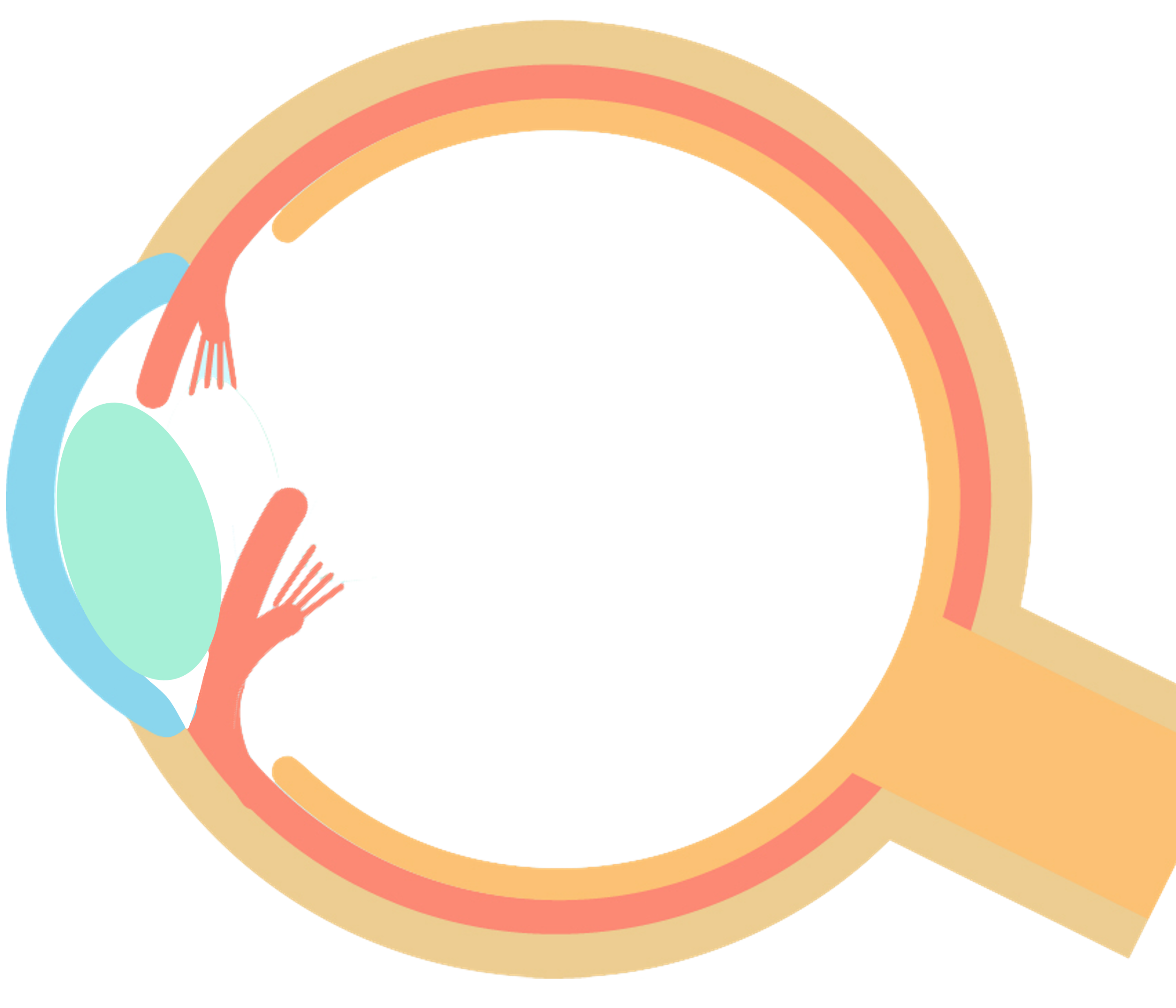 水晶体前方脱臼