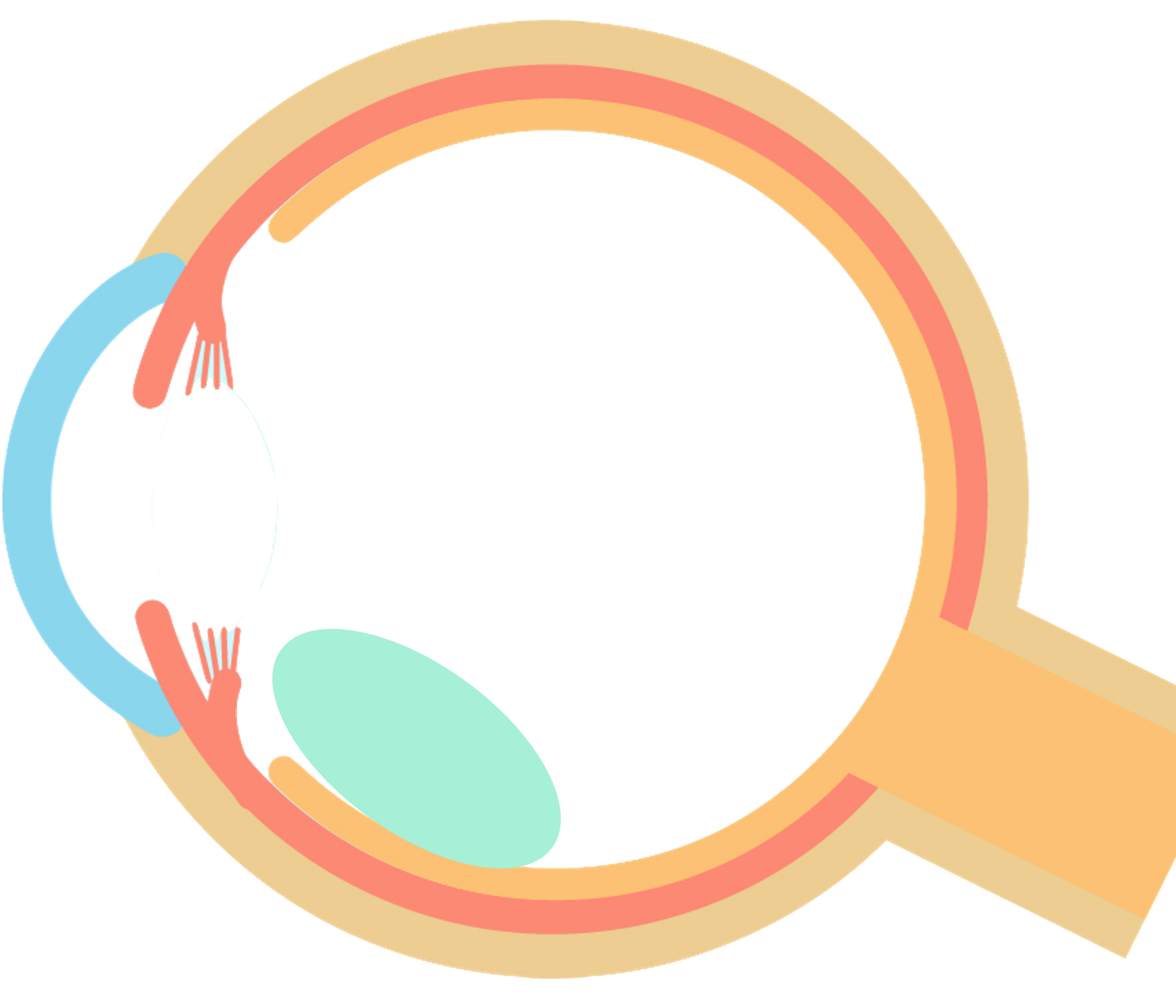 水晶体後方脱臼