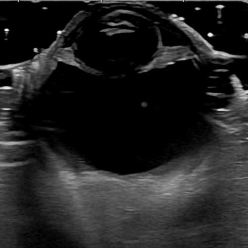 水晶体脱臼 エコー