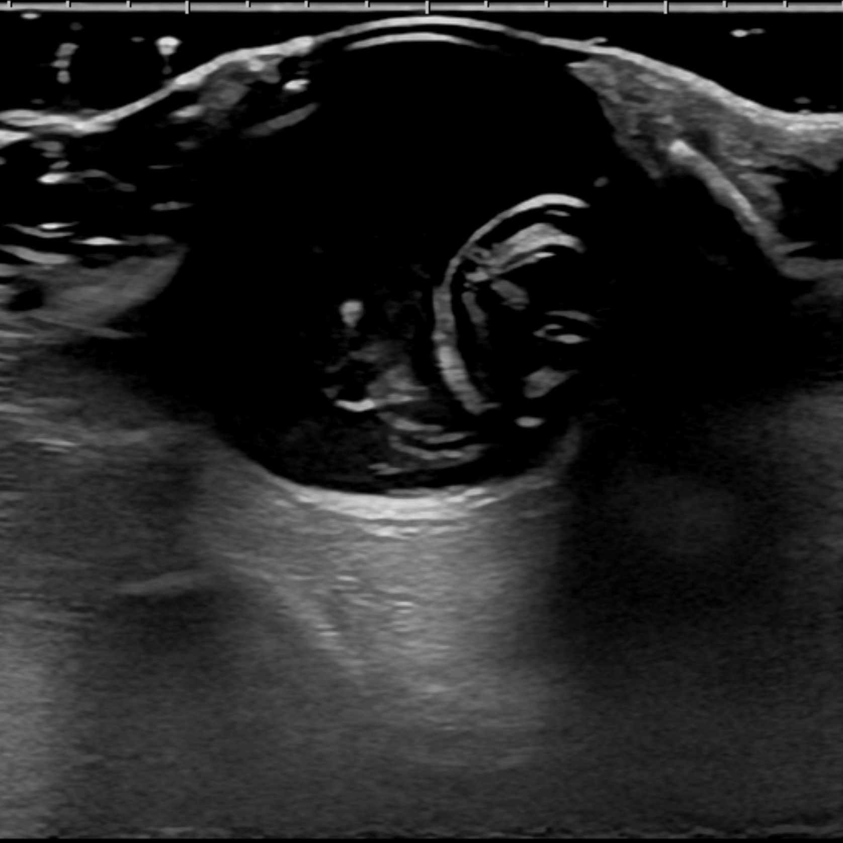 水晶体脱臼 超音波