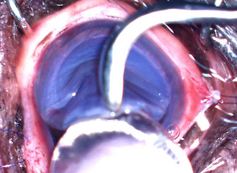 水晶体摘出術 術式