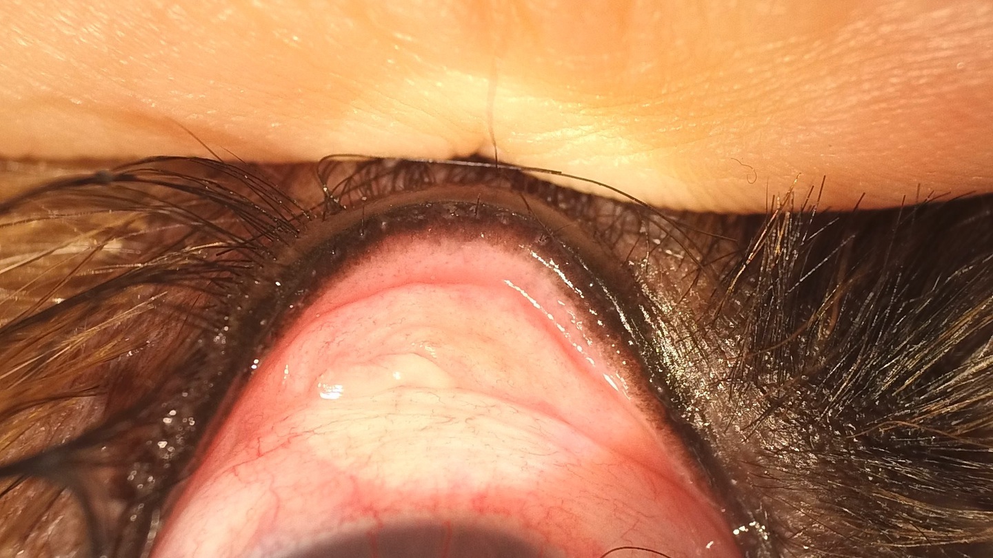 マイボーム腺の開口部