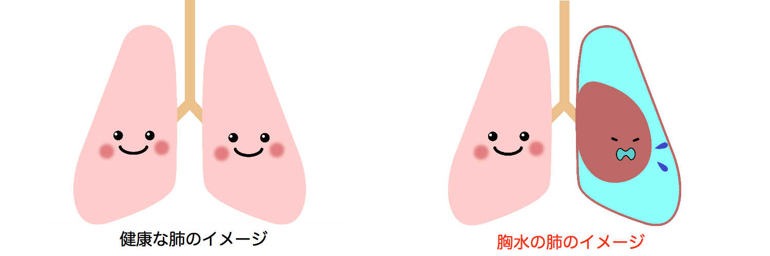 乳癌 肺 に 水 が たまる