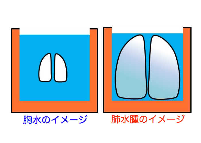 肺 に 水 が 溜まる 症状